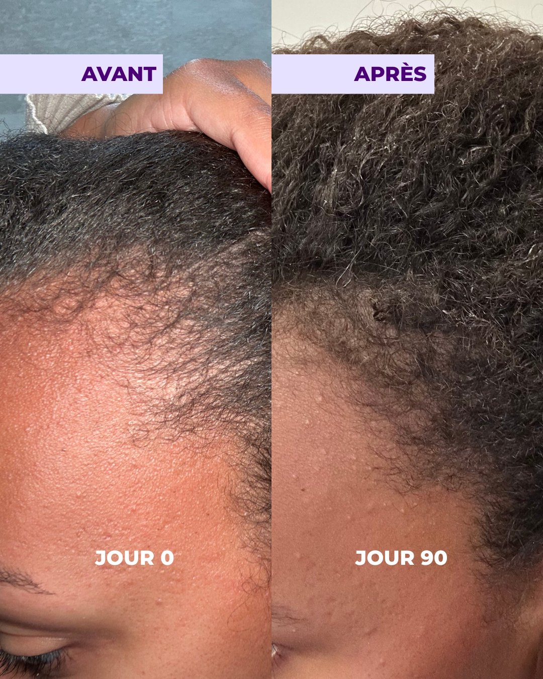 Gummies Pousse de cheveux à la vitamine D3