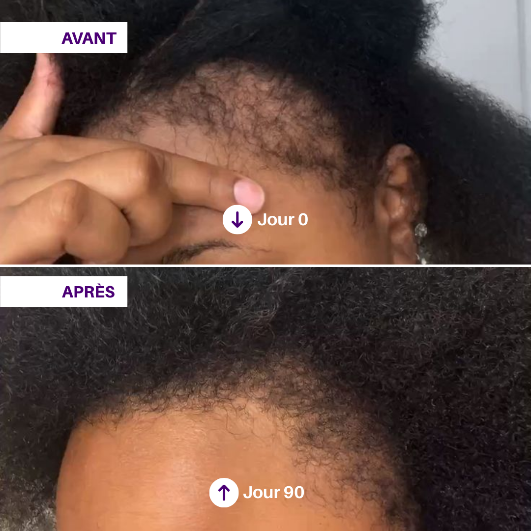 Gummies Pousse de cheveux à la vitamine D3