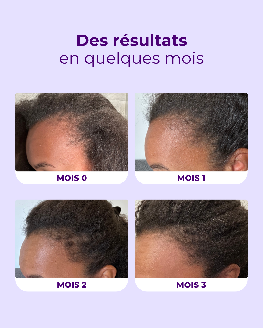 Gummies Pousse de cheveux à la vitamine D3